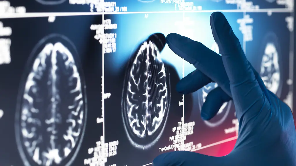 Neurology-Research-Doctor-examining-a-human-brain-scan-on-screen-Modellfreigabe-vorhanden