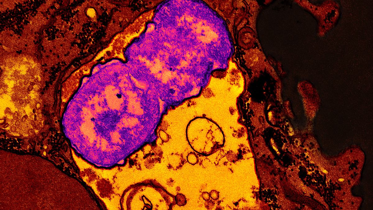 Wenn Antibiotika versagen: RKI warnt vor Zunahme resistenter Super-Erreger