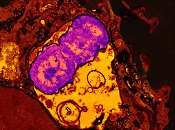 Wenn Antibiotika versagen: RKI warnt vor Zunahme resistenter Super-Erreger