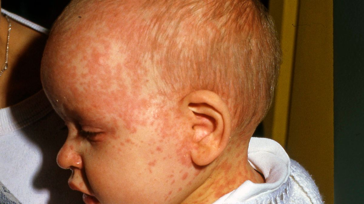 WHO: Zahl der Toten inakzeptabel: Masern bleiben weiterhin gefährlich