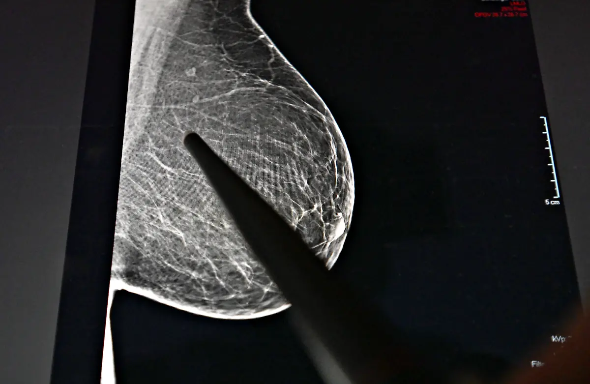 ABD0085-20251119-SALZBURG-OeSTERREICH-THEMENBILD-Illustration-zum-Thema-Mammografie-Brustkrebsvorsorge-Brustkrebs-Frueherkennung-Radiologie-Roentgen-Frauen-Gesundheit-Ein-digitales-Brustroentgenbild-aufgenommen-am-Mittwoch-19-November-2025