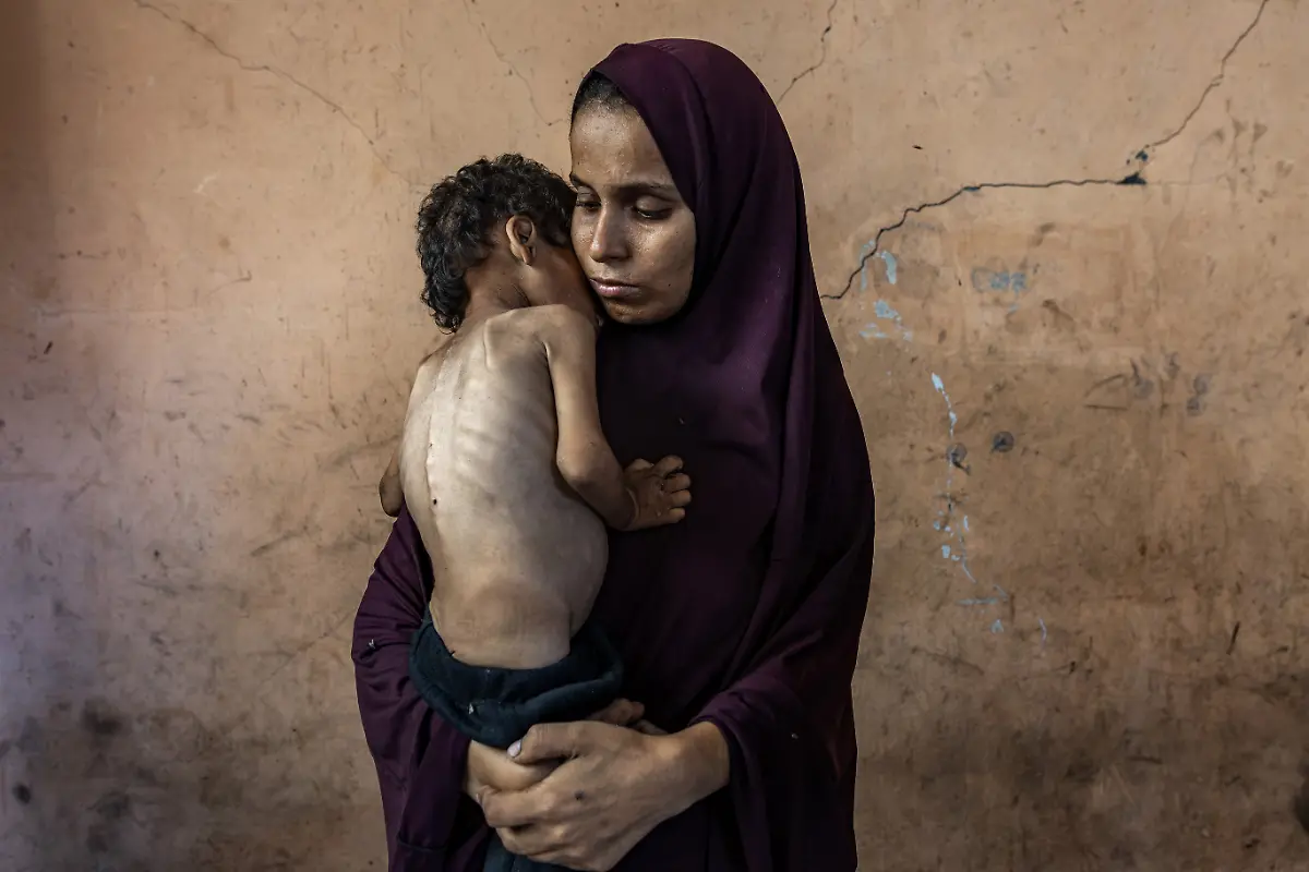 Yazan-Abu-Foul-a-two-year-old-child-suffers-from-severe-malnutrition-amid-deteriorating-health-conditions-He-and-his-family-live-in-the-remains-of-their-destroyed-home-in-Al-Shati-refugee-camp-west-of-Gaza-City-His-mother-Naima-Abu-Foul-is-30-years-old-and-has-four-children-She-is-pregnant-with-her-fifth-child