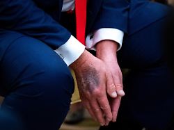 Jeden Tag mehrere Aspirin: Trump erklärt seltsame Blutergüsse auf seinen Händen