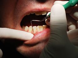 Mittel für gesundes Zahnfleisch: Neue Zahnpasta stoppt gezielt Parodontitis-Erreger