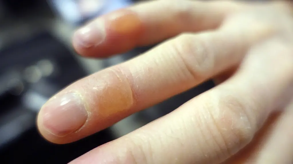 23-01-2016-Aekaeskero-Lappland-Finnland-Erfrierung-Blasen-an-Fingern-einer-Hand-00S160123D456