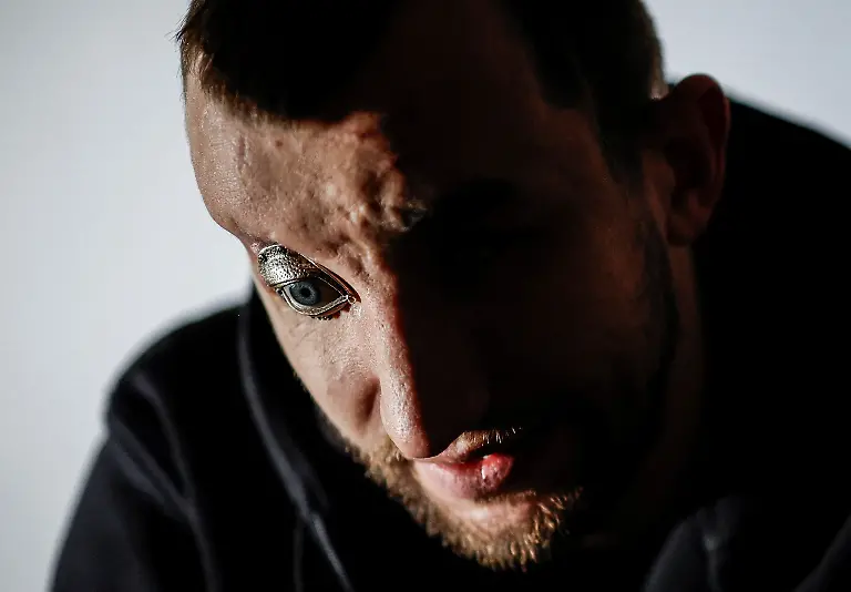 Ukrainian-soldier-Andrii-Onopriienko-31-who-lost-both-eyes-when-two-Russian-anti-tank-rounds-struck-his-position-in-the-eastern-city-of-Avdiivka-in-2023-rehearses-with-the-Veterans-Theatre-for-an-18th-century-Ukrainian-parody-of-Virgil-s-Aeneid-amid-Russia-s-attack-on-Ukraine-in-Kyiv-Ukraine-November-19-2025-Like-the-other-veterans-in-his-Kyiv-based-group-of-around-15-actors-Onopriienko-has-found-healing-and-fulfilment-on-stage-after-a-friend-told-him-about-a-theatre-looking-for-injured-veterans-and-suggested-he-join-Yes-we-might-not-have-an-arm-or-legs-or-eyes-but-we-aren-t-giving-up-he-said-It-s-rehabilitation-and-socialisation-it-s-positive-emotions-REUTERS-Alina-Smutko-SEARCH-UKRAINE-SMUTKO-THEATRE-FOR-THIS-STORY-SEARCH-WIDER-IMAGE-FOR-ALL-STORIES