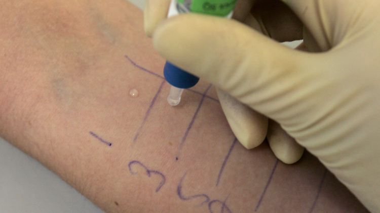 Bei ungeklärter Ursache von entzündeten Augen sollte ein Allergietest gemacht werden.