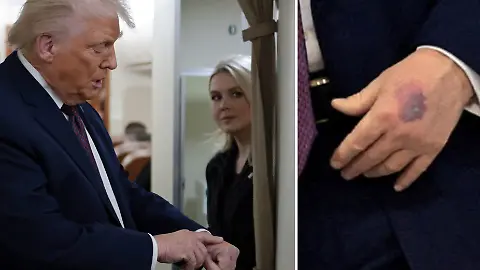 Trumps hand