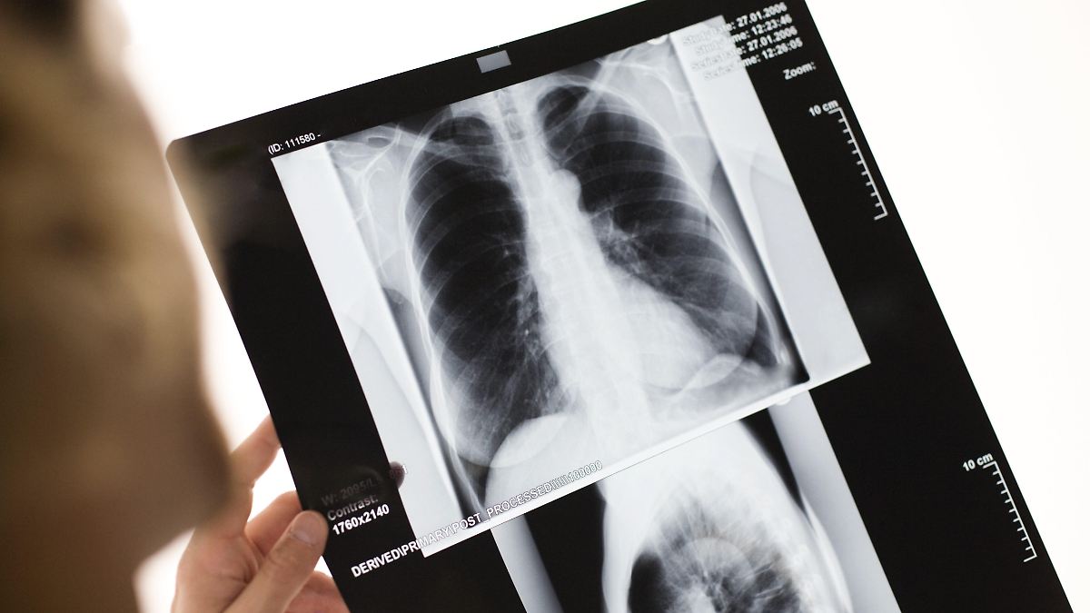 Rauchen-Alkohol-Adipositas-Studie-Fast-40-Prozent-aller-Krebsf-lle-sind-vermeidbar