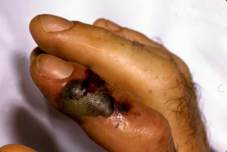 Doctors-Without-Borders-says-the-world-will-run-out-of-one-of-the-most-effective-treatments-for-snakebites-next-year-putting-the-lives-of-tens-of-thousands-of-people-at-risk-mostly-in-developing-countries-In-a-statement-issued-on-Monday-the-medical-charity-warned-that-existing-stockpiles-of-the-anti-venom-Fav-Afrique-produced-by-Sanofi-Pasteur-will-expire-in-June-The-company-stopped-producing-the-anti-venom-last-year-and-has-since-switched-to-MCHmaking-a-rabies-treatment-instead