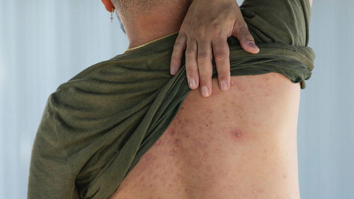 M&ouml;glicher Ursprung des Affenpockenvirus entdeckt