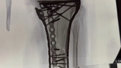 vonn