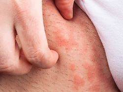 Juckreiz und Quaddeln überall: Was ist Nesselsucht und wodurch wird sie ausgelöst?