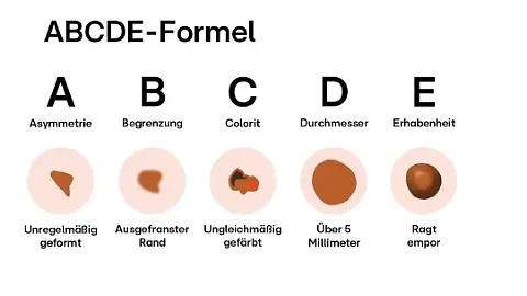 Leberfleck-Formel