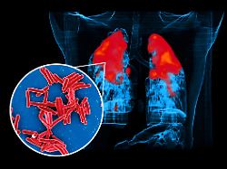 WHO: Hohe Dunkelziffer: Tuberkulose wird für Europa zunehmend zur tödlichen Gefahr