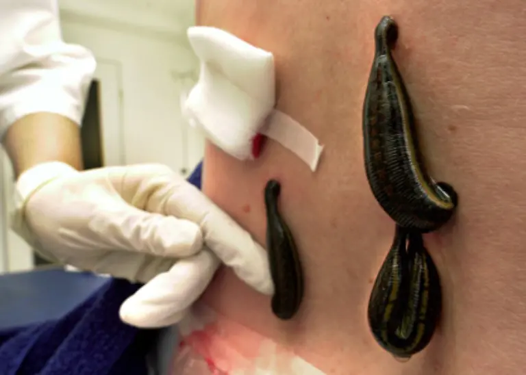 In-Absprache-mit-dem-behandelnden-Arzt-sind-auch-verschiedene-Alternativbehandlungen-wie-das-Ansetzen-von-Blutegeln