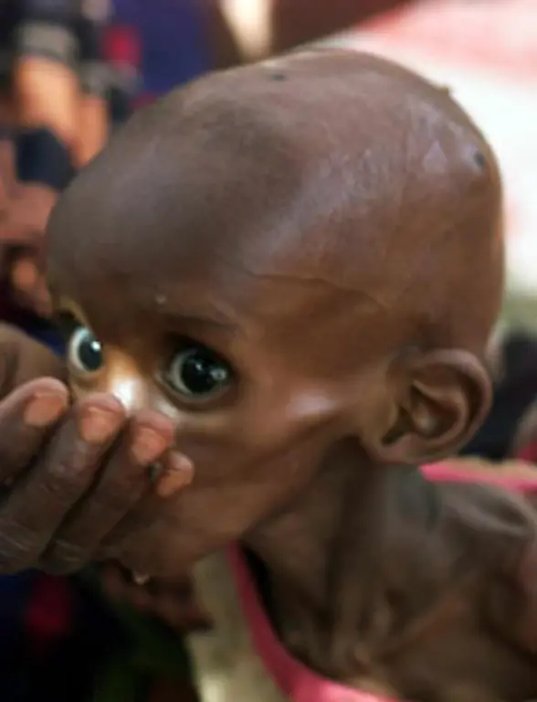 Afrika-ist-der-Kontinent-der-Hungersnoete-Es-gibt-keine-selbstproduzierten-hochkalorischen-Lebensmittel