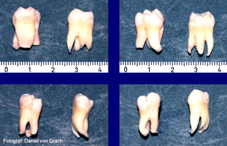 Da-das-Durchbrechen-der-Weisheitszaehne-wegen-Platzmangels-meist-zu-einem-gesundheitlichen-Problem-wird-werden-sie-oft-gezogen-oder-sogar-vor-ihrem-Durchbrechen-operativ-entfernt