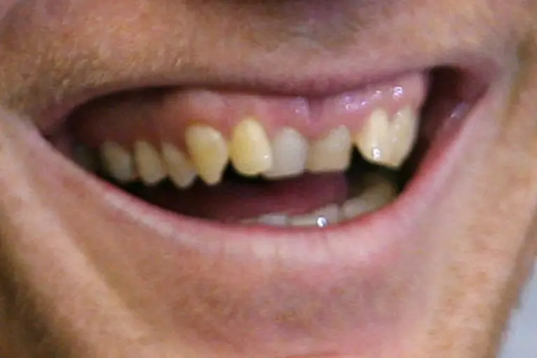 Auch-angeborene-oder-durch-Nuckeln-erworbene-Zahnfehlstellungen-koennen-zu-gesundheitlichen-Einschraenkungen-wie-Kopfschmerzen-Tinnitus-oder-Magen-Darm-Beschwerden-fuehren