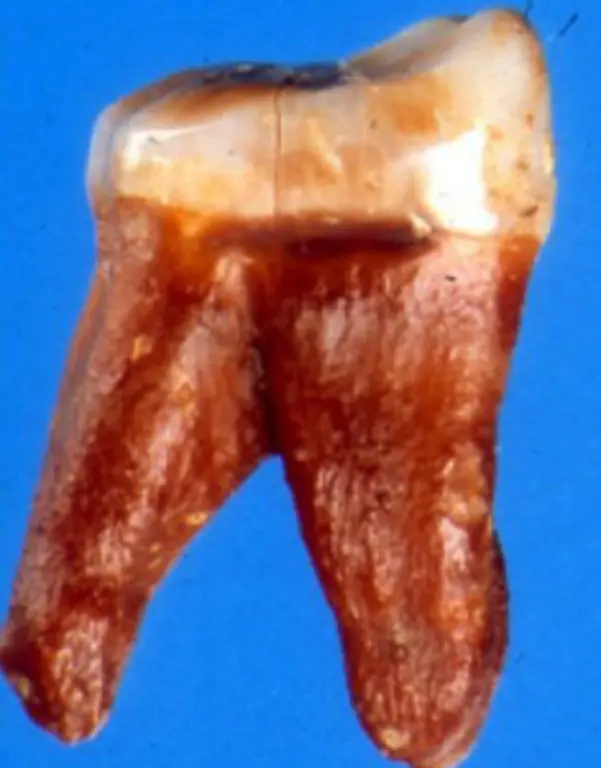 Der-Zahn-selbst-ist-aus-mehreren-Schichten-aufgebaut-Im-Mund-sieht-man-nur-den-Zahnschmelz-der-wie-eine-Glasur-das-innen-liegende-Zahnbein-Dentin-bedeckt-Das-Dentin-wiederum-umschliesst-das-Zahnbein-Pulpa-Ein-Zahn-ist-scheinbar-einfach-strukturiert