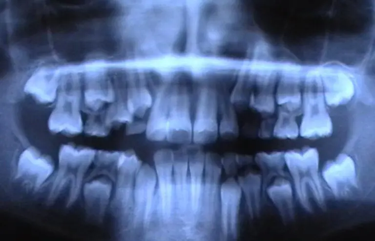 Viele-Saeugetiere-bilden-wie-auch-der-Mensch-zunaechst-ein-Milchgebiss-aus-das-beim-Heranwachsen-durch-das-bleibende-Gebiss-ersetzt-wird