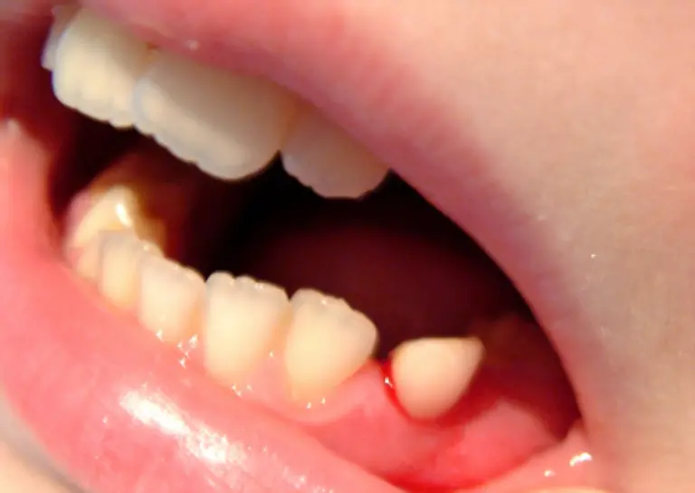 Erst-wenn-er-durch-das-Zahnfleisch-durchgebrochen-ist-meist-im-fuenften-Lebensjahr-werden-Milchzaehne-zu-Wackelzaehnen