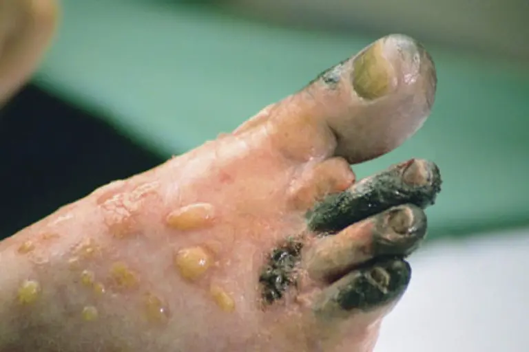 Weit-verbreitet-das-Raucherbein-Durch-Gefaessverengungen-der-Arterien-wird-das-Bein-nicht-mehr-ausreichend-durchblutet-das-Gewebe-stirbt-ab-Jaehrlich-werden-in-Deutschland-rund-10-000-Raucherbeine-amputiert