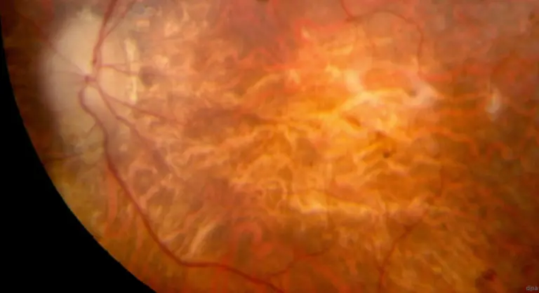 und-verursacht-Schaeden-an-der-Netzhaut-die-bis-zur-voelligen-Erblindung-fuehren-koennen