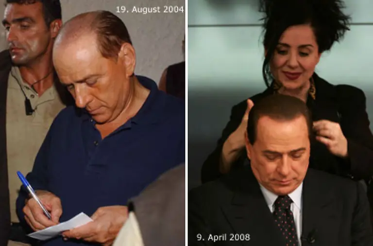 Im-Sommer-2004-laesst-er-sich-Haare-auf-seine-Kopfhaut-transplantieren-auf-dem-Bild-vom-19-August-hat-er-diesen-Eingriff-bereits-hinter-sich