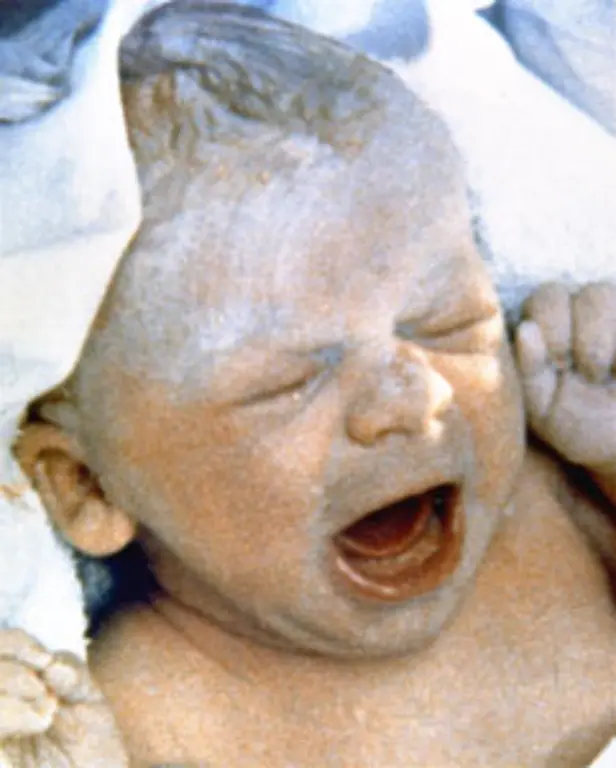 Die-Weltpresse-schlug-vor-dem-Oldham-and-District-Hospital-nahe-Manchester-ihre-Zelte-auf-und-wurde-Zeuge-als-Louise-geboren-wurde