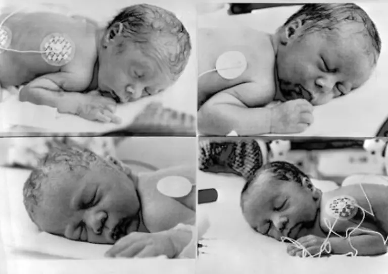 Eine-haeufigere-Komplikation-der-kuenstlichen-Befruchtung-sind-Mehrlingsschwangerschaften-Im-Jahr-2000-waren-genau-15-6-Prozent-aller-IVF-Geburten-Zwillinge-und-1-6-Prozent-sogar-Drillinge