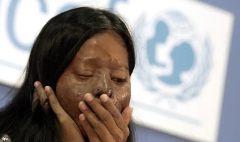 Frauen-und-Maedchen-in-Asien-werden-Opfer-von-Saeureanschlaegen-ohne-dass-dies-zu-strafrechtlichen-Verfolgungen-fuehrt