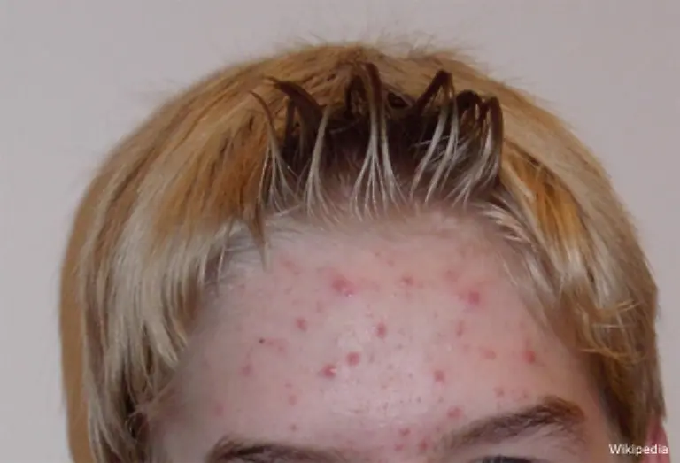 wenn-Jungs-im-gleichen-Alter-wegen-taeglich-neuer-Pickel-verzweifeln