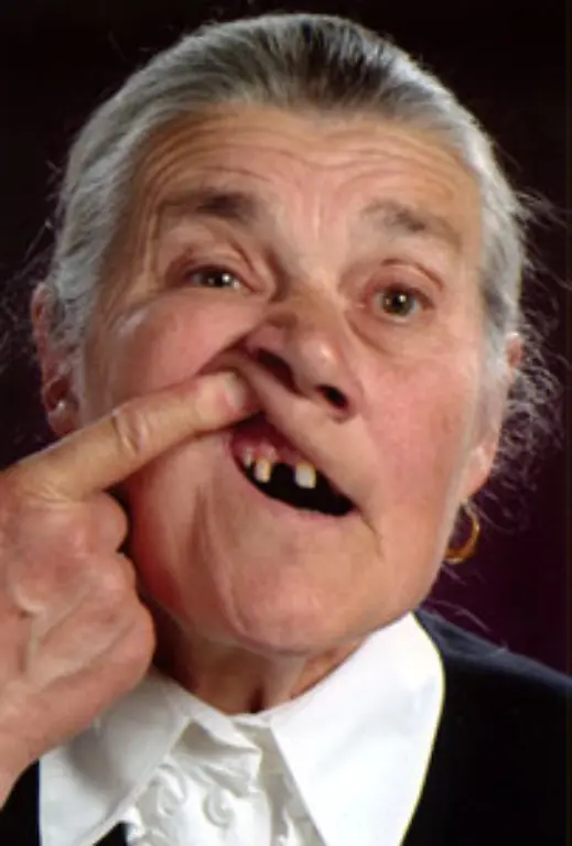 Aelteste-Person-mit-einem-neuen-Zahn-Im-Maerz-2007-brach-bei-Mria-Magdolna-Pozderka-Ungarn-geb-am-19-Juli-1938-die-damals-68-Jahre-alt-war-oben-rechts-ein-Eckzahn-durch