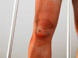 Kniegenksspiegelung Knee Joint Mirroring 1033003193