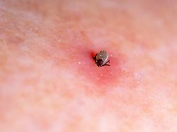 Blutsaugende Zecke Auf Geroeteter Haut Dir Krankheitsuebertragung Durch Eine Zecke Wie Hier Der Gemeine Holzbock Kann Krankheiten Wie FSME Oder Borreliose Zu Folge Haben