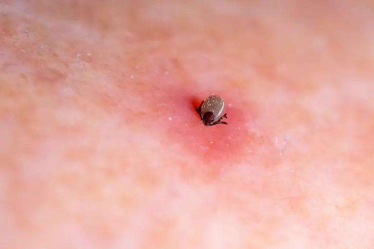 Blutsaugende-Zecke-auf-geroeteter-Haut-Dir-Krankheitsuebertragung-durch-eine-Zecke-wie-hier-der-Gemeine-Holzbock-kann-Krankheiten-wie-FSME-oder-Borreliose-zu-Folge-haben