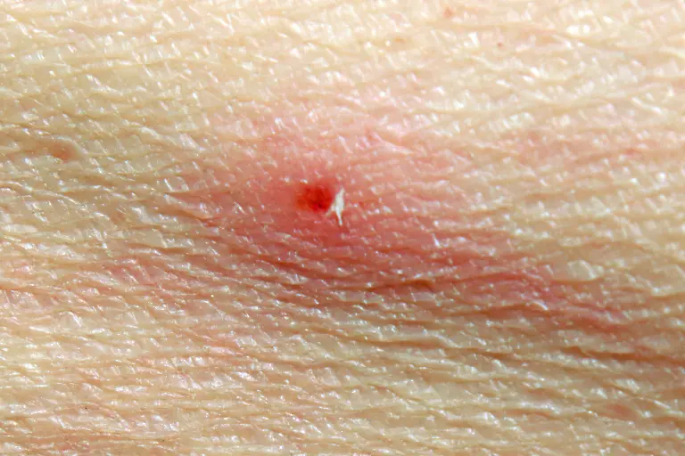 Einstichstelle-einer-Zecke-Ein-Zeckenstich-im-Oberschenkel-eines-Menschen-Tick-bite-A-tick-bite-in-the-thigh-of-a-human