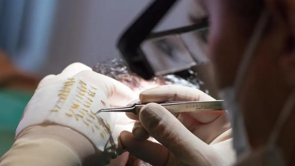 Eine-Haartransplantation-wird-durchgefuehrt