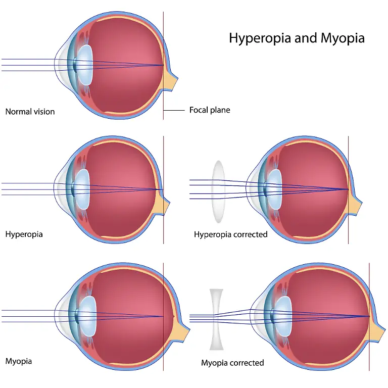 Myopia-and-hyperopia
