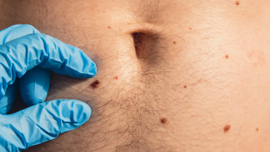 Dermatologist-checking-male-birthmarks-Doctor-in-medical-gloves-examining-man-skin-mole-Self-care-preventing-cancer-procedure-Protection-treatment