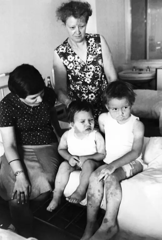 Die-Schwestern-Stefania-l-und-Alice-Senne-r-mit-ihrer-Mutter-und-ihrer-Grossmutter-im-Krankenhaus-Niguarda-in-Mailand-am-05-08-1976-Die-Maedchen-werden-wegen-Hautproblemen-an-Beinen-und-Gesicht-behandelt-die-nach-dem-Chemieunfall-von-Seveso-aufgetreten-sind-Am-10-7-1976-war-aus-einem-undichten-Kessel-des-Chemiewerkes-Icmesa-am-Stadtrand-der-Gemeinde-Meda-nahe-Mailand-eine-Giftgaswolke-explosionsartig-ausgetreten-Durch-den-Wind-verteilte-sie-sich-auf-ein-weites-Gebiet-suedlich-von-Meda-und-sank-schliesslich-in-der-Nachbargemeinde-Seveso-nieder-Erst-nachdem-am-14-7-Blaetter-von-den-Baeumen-fielen-und-Kleintiere-eingingen-wurden-Proben-des-Giftes-analysiert-Es-handelte-sich-um-die-hochgiftige-organische-Substanz-Tetrachlordibenzodioxin-kurz-TCDD