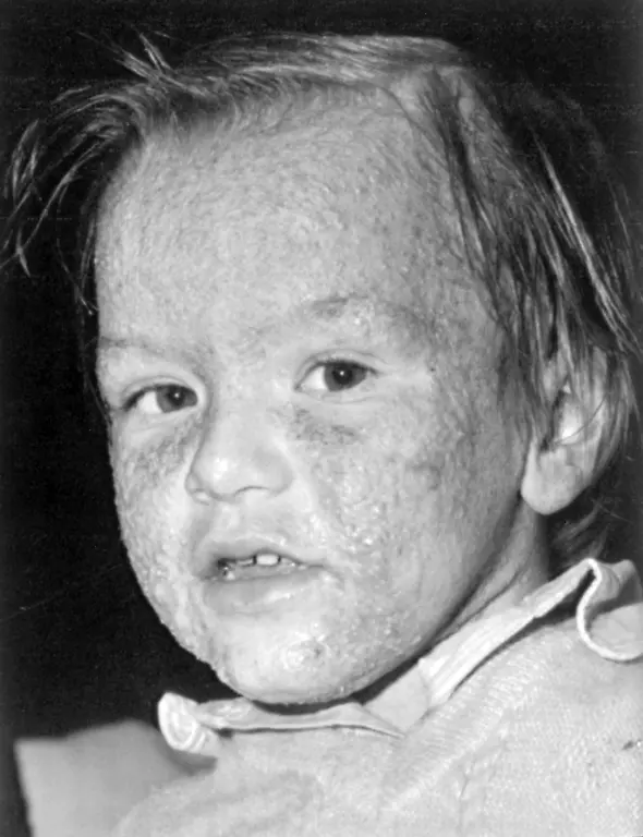 Four-year-old-Alice-Senno-her-beautiful-face-disfigured-by-a-serious-skin-disease-is-pictured-at-her-home-of-Meda-a-village-not-far-from-the-polluted-area-of-Seveso-Friday-night-Oct-29-1976-The-small-girl-was-hospitalized-last-August-in-Milan-suffering-from-sores-caused-by-a-poisonous-cloud-of-chemicals-spread-from-the-Swiss-owned-firm-in-Seveso-where-the-child-lived