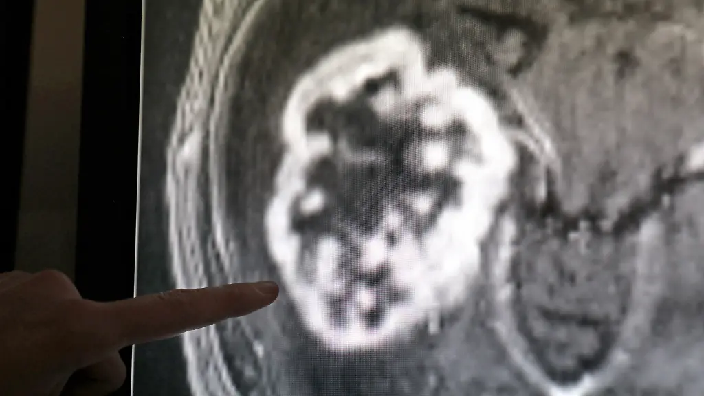 In-der-Diagnostik-der-Radiologie-der-Universitaetsmedizin-Rostock-wird-mit-Hilfe-der-Magnetresonanztomographie-ein-Tumor-festgestellt