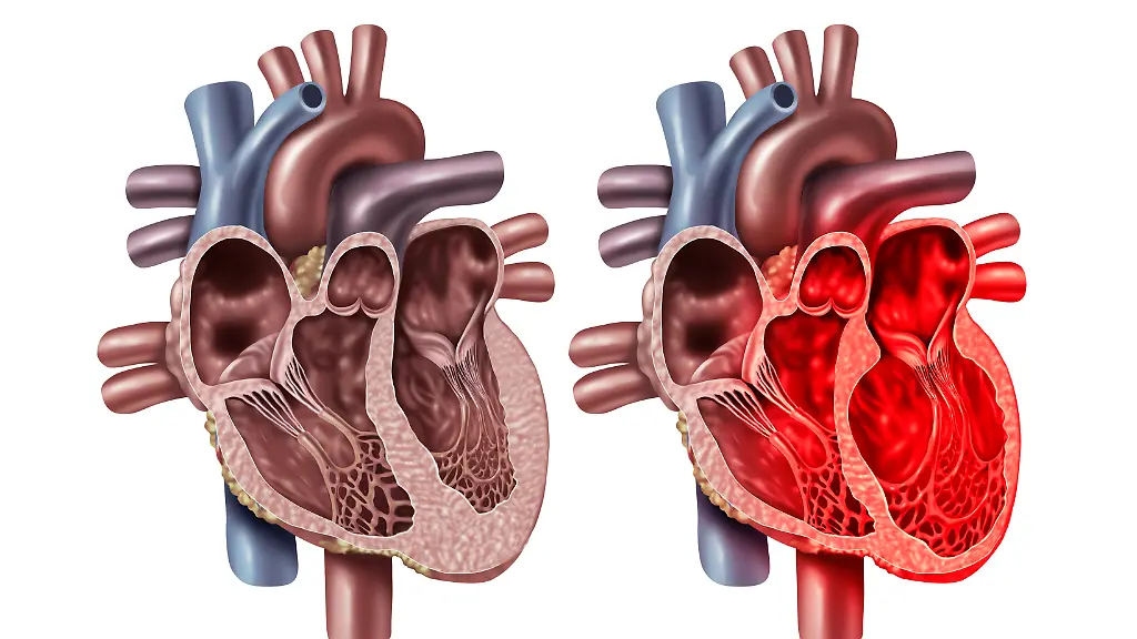 Broken-Heart-Syndrome-or-Takotsubo-cardiomyopathy-with-a-healthy-organ-anatomy-cross-section-concept-of-an-inner-cardiovascular-organ