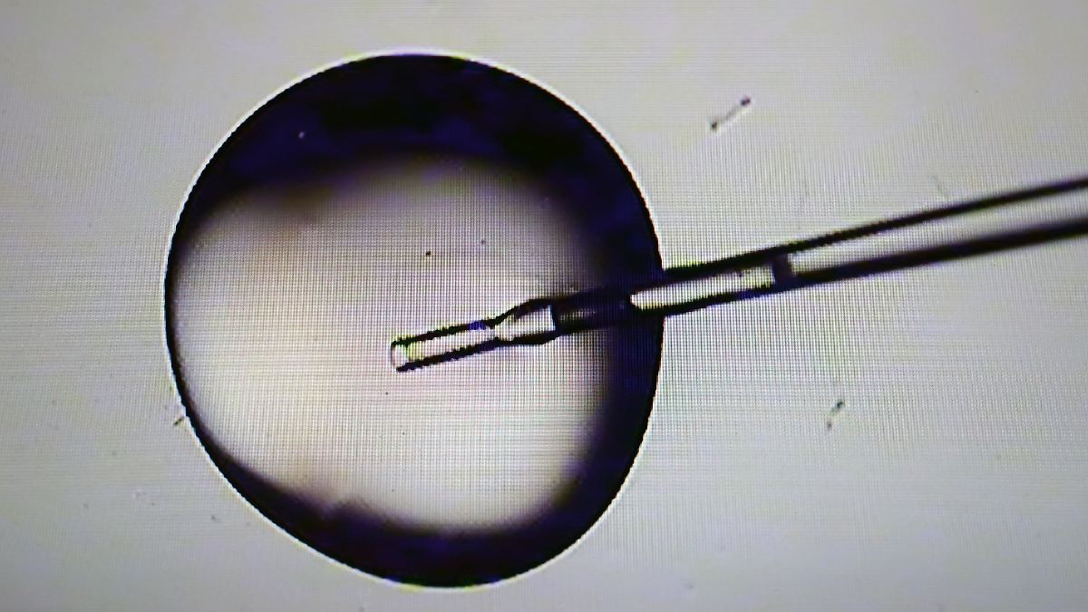 Frau in Italien wird fremder Embryo implantiert