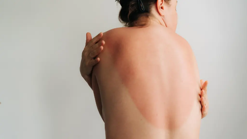 View-of-the-sunburned-skin-of-a-woman-s-back