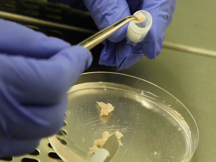 Es ist die weltweit erste erfolgreiche Transplantation von Eierstockgewebe bei Zwillingsschwestern.