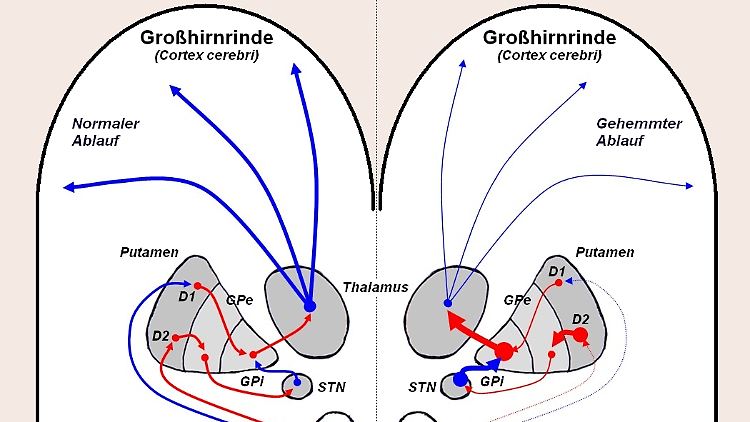 Grafische Darstellung des Dopaminausstoßes beim gesunden (links) und beim Parkinson-Erkrankten (rechts).