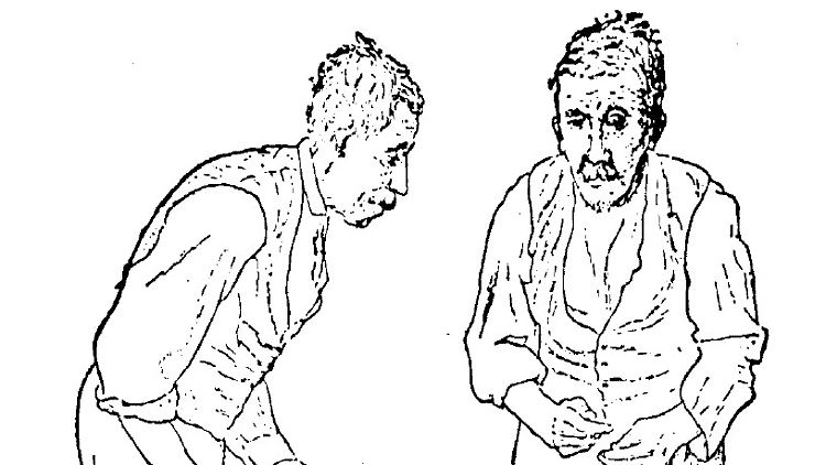 Illustration der Parkinson-Krankheit von Sir William Richard Gowers (1886).